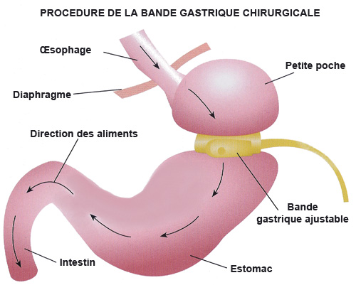 photo pour onglet anneau gastrique